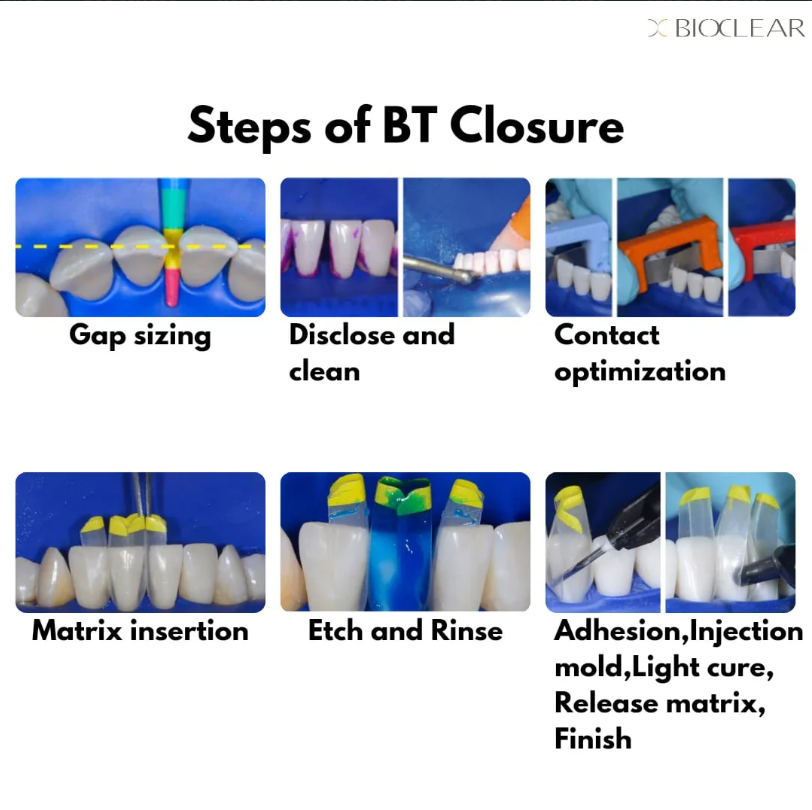 Black Triangle Procedure Kit (#801010)